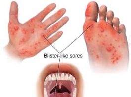 foot and mouth disease
