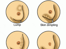 Breast Cancer