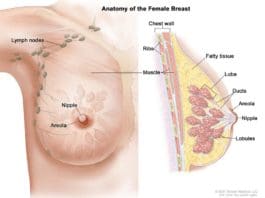 Breast Cancer