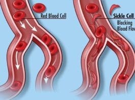 Sickle Cell