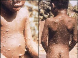 Undated photo currently posted on the website of the U.S. Centers for Disease Control and Prevention (CDC) shows a child affected with monkeypox. (Courtesy of CDC)