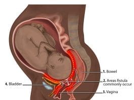 Obstetric Fistula Locations Diagram