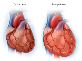 Heart Failure