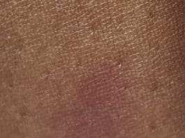 Insect bite
