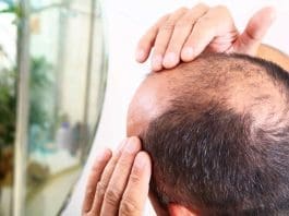 https://www.artistryclinic.co.uk/wp-content/uploads/2023/02/alopecia-male-hair-loss-1.jpg