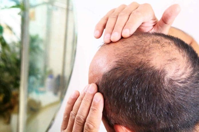 https://www.artistryclinic.co.uk/wp-content/uploads/2023/02/alopecia-male-hair-loss-1.jpg