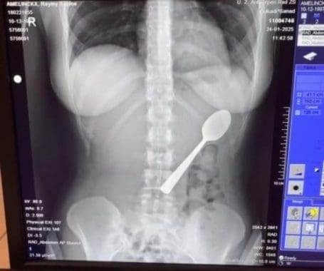 Belgian Woman Survives After Swallowing 17cm Spoon in Dog Mishap